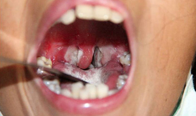 NHỮNG ĐIỀU CẦN BIẾT VỀ BỆNH BẠCH HẦU