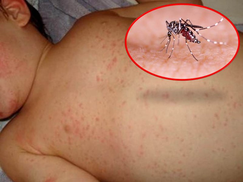 Sốc sốt xuất huyết Dengue rất hay gặp ở trẻ em.