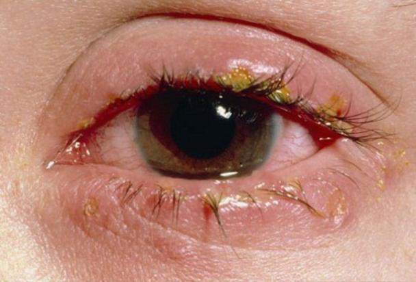 Nguyên nhân gây đau mắt đỏ theo đông y do bế tắc kinh mạch gây ra.