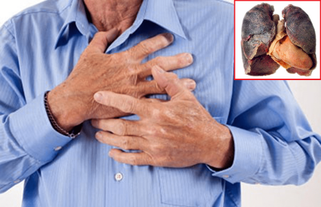 Tức ngực, khó thở có thể là biểu hiện của ung thư phổi cần cảnh giác.