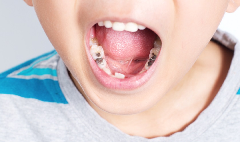 Sâu răng là một trong những bệnh lý về răng miệng phổ biến ở mọi lứa tuổi, đặc biệt là ở trẻ em.