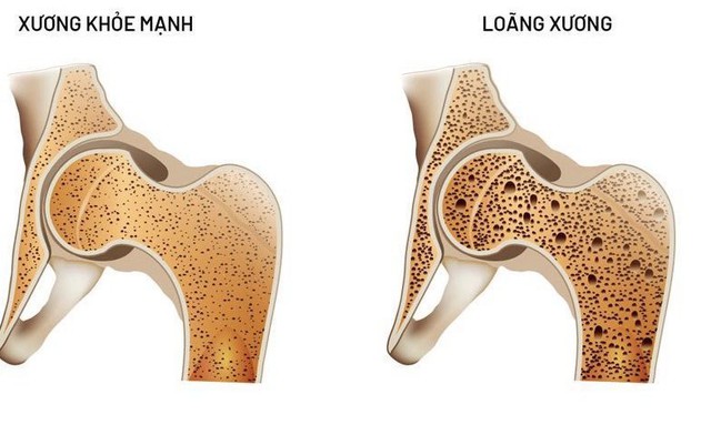 Thiếu mangan có thể dẫn đến loãng xương.