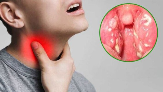 Bạch hầu là một bệnh nhiễm trùng mũi họng cấp tính, dễ gây tử vong vì vậy cần được phát hiện và điều trị sớm.