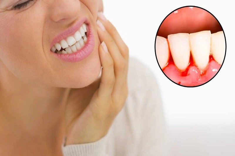 Viêm nướu răng là bệnh lý răng miệng do sự tích tụ của các mảng bám chứa vi khuẩn gây viêm mô nướu xung quanh răng.