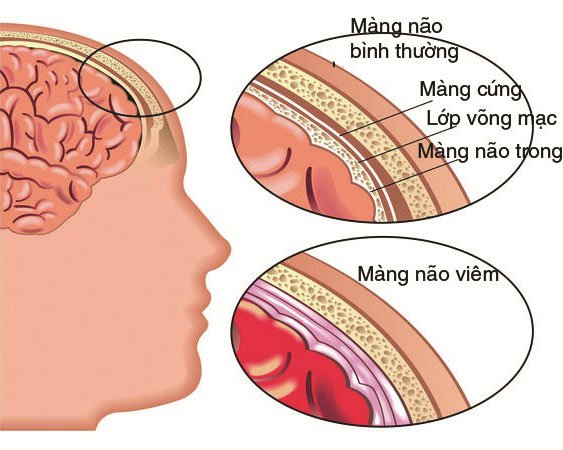 Bệnh viêm màng não do não mô cầu.