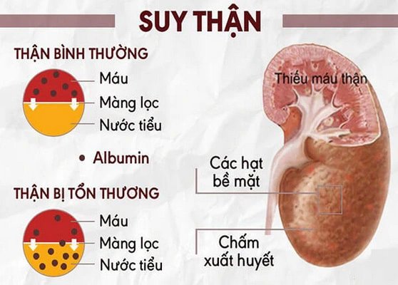 Một số bệnh thận thường gặp và nguyên nhân