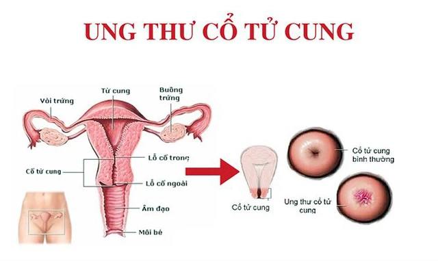 Khi một người nhiễm HPV không tự khỏi sẽ tiến triển thành ung thư cổ tử cung.