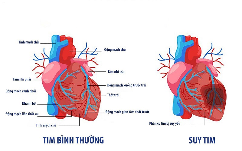 Suy tim là bệnh lý nguy hiểm, đe dọa trực tiếp đến sự sống