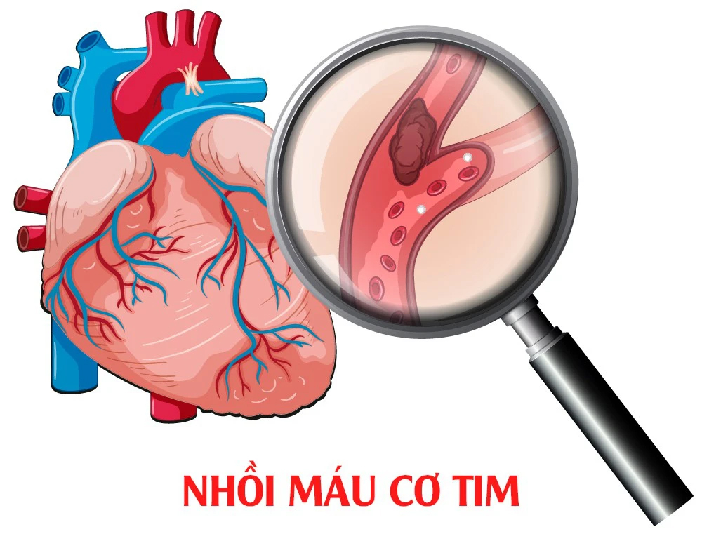 Những dấu hiệu cảnh báo nhồi máu cơ tim cần biết