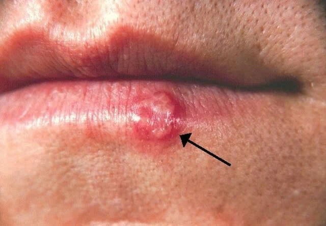 Herpes gây ra các vết loét khiến người bệnh có cảm giác đau rát.