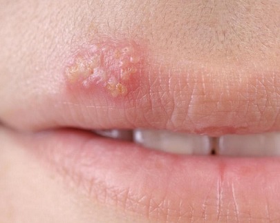 Herpes sinh dục có thể gây ra các vết loét và mụn nước đau đớn xung quanh môi, bộ phận sinh dục...