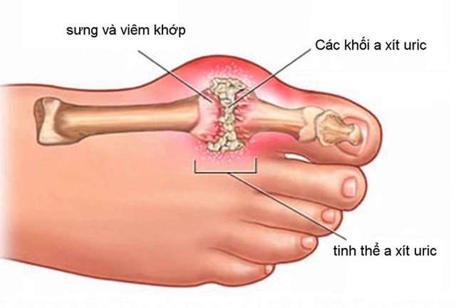 Gout cần được điều trị ngay lập tức sau khi phát hiện bệnh.