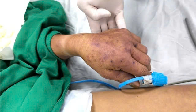 Bệnh nhân nhập viện trong tình trạng nhiều ban tím và khó thở.
