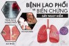 HƯỞNG ỨNG NGÀY THẾ GIỚI PHÒNG CHỐNG BỆNH LAO