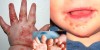 Nhận biết trẻ bị bệnh Tay chân miệng