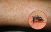 PHÂN BIỆT SỐT XUẤT HUYẾT VÀ SỞI - SỐT PHÁT BAN