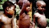 TÌM HIỂU VỀ BỆNH ĐẬU MÙA KHỈ