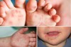 PHÒNG CHỐNG BỆNH TAY CHÂN MIỆNG
