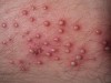 Viêm nang lông thường do vi khuẩn, nấm gây ra.
