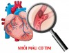 Đau ngực dữ dội cảnh báo nguy cơ nhồi máu cơ tim