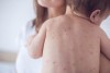 Sởi là một bệnh truyền nhiễm cấp tính do virus gây ra.