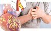 BỆNH MẠCH VÀNH MẠN – CÁCH NHẬN BIẾT VÀ ĐIỀU TRỊ HIỆU QUẢ