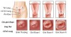 Các giai đoạn ung thư tử cung