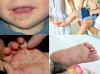Đã có trẻ tử vong nghi mắc tay chân miệng: 6 khuyến cáo của Bộ Y tế phòng chống bệnh cần biết