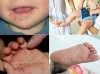 6 khuyến cáo phòng chống bệnh Tay chân miệng