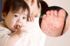 Bệnh tay chân miệng do virus gây ra nên không có thuốc điều trị đặc hiệu.