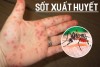 Sốt xuất huyết truyền bệnh thế nào?