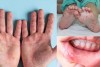 Bệnh tay chân miệng có nốt phỏng nước tập trung tại các vùng lòng bàn tay, bàn chân, mông,...