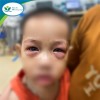 Trẻ bị viêm kết mạc cấp (hay còn gọi là đau mắt đỏ).