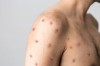 Mụn nước trên thân một người mắc đậu mùa khỉ.