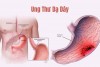 Vị trí ung thư dạ dày.