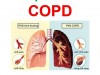 So sánh giữa phổi của người bình thường và phổi của người mắc bệnh COPD.