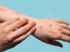 TĂNG CƯỜNG CÁC BIỆN PHÁP PHÒNG CHỐNG BỆNH ĐẬU MÙA KHỈ