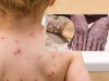 Cảnh báo bệnh đầu mùa khỉ nguy hiểm