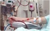 Lọc máu thường được áp dụng cho trường hợp bệnh thận đã tiến triển nặng.