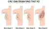 Các giai đoạn ung thư vú.