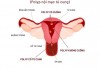 Hình ảnh polyp tử cung.