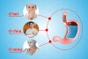 Ợ hơi, ợ chua, ợ nóng đều có nguyên nhân liên quan đến trào ngược dạ dày