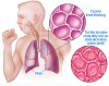 Viêm phổi là bệnh về đường hô hấp rất phổ biến.