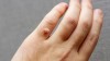 Mụn cóc trên tay - dấu hiệu phổ biến do virus HPV gây ra. Tuy không nguy hiểm nhưng cần điều trị sớm để tránh lây lan