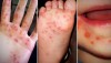 Trẻ mắc tay chân miệng có những biểu hiệu này, cha mẹ cần đưa ngay đến bệnh viện