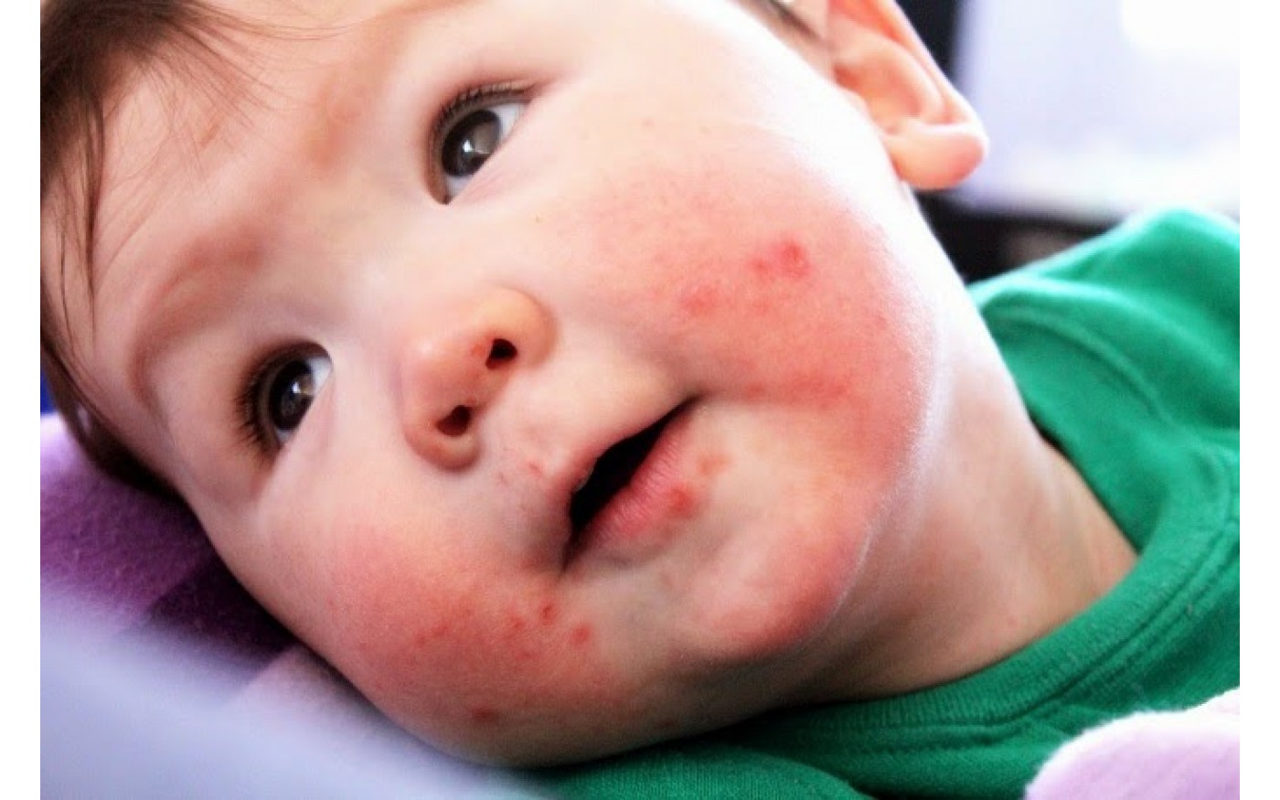 Bệnh Tay chân miệng ở trẻ em