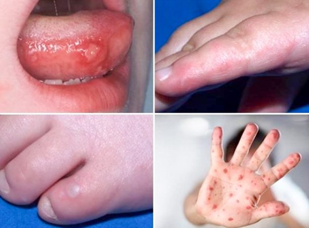 Bệnh tay chân miệng, cảnh giác biến chứng nặng