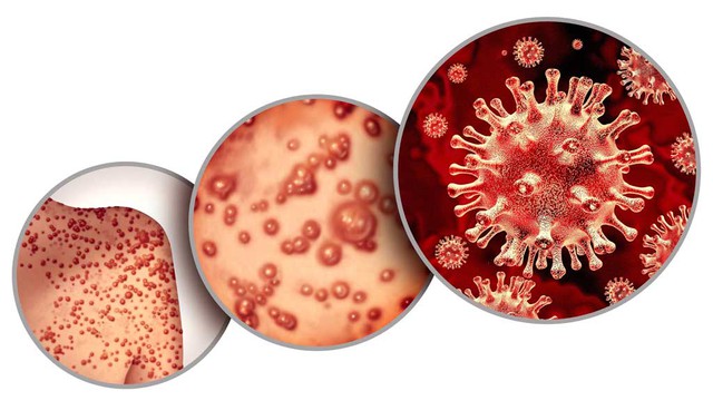 Người nhiễm HIV dễ có nguy cơ mắc đậu mùa khỉ.