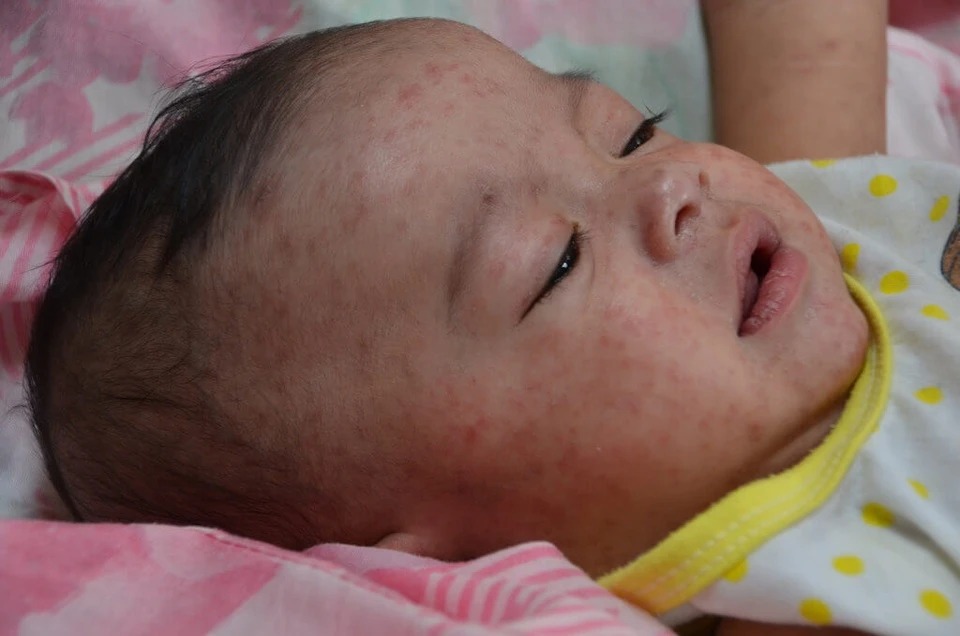 Trẻ sơ sinh có nguy cơ mắc sốt xuất huyết nặng cao hơn người lớn khỏe mạnh vì hệ thống miễn dịch của chúng yếu hơn.