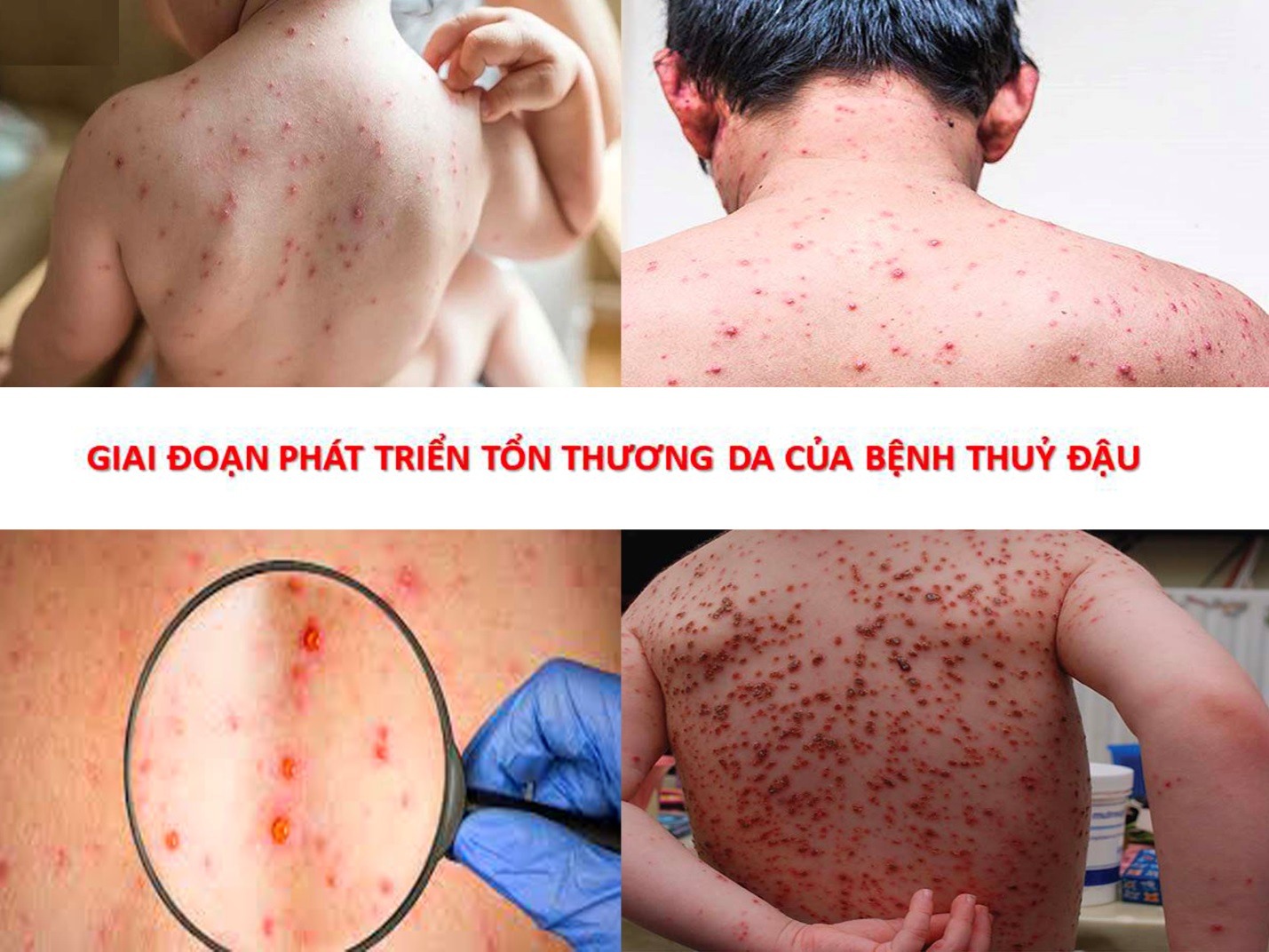 TUYÊN TRUYỀN PHÒNG CHỐNG BỆNH THỦY ĐẬU